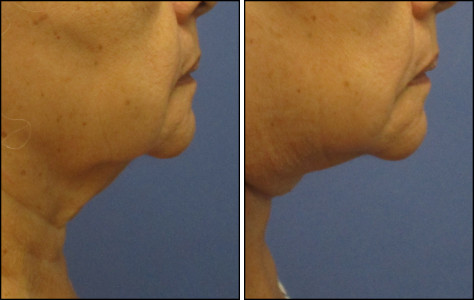 facelift
